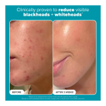 Pore Solutions Kit (Holiday Limited Edition) - Image 3